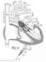 Fig. 12 - Heart valve and method for insertion of the heart valve into a bodily vessel