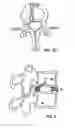 Fig. 08 - Method of anchoring an implant in an intervertebral disc