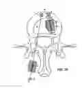Fig. 09 - Method of anchoring an implant in an intervertebral disc