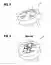 Fig. 07 - Receiving optical subassembly with an improved high frequency performance