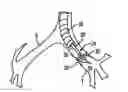 Fig. 01 - Apparatus for treating asthma using neurotoxin