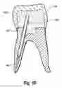 Fig. 10 - Kit of sub-kits for placing a dental post