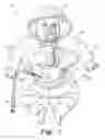 Fig. 02 - Peritoneal dialysis doll