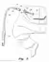 Fig. 04 - Peritoneal dialysis doll