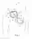 Fig. 02 - Methods and apparatus for reducing spurious signals in implantable medical devices caused by x-ray radiation