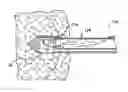 Fig. 01 - Methods and devices for removing tissue from a patient and placing a marker in the patient
