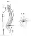 Fig. 02 - SUBARACHNOID EPIDURAL SHUNT