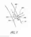 Fig. 06 - Methods for minimally invasive vascular access