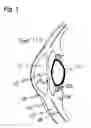 Fig. 02 - Method and system for non-invasive treatment of hyperopia, presbyopia and glaucoma