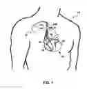 Fig. 02 - Delivery of CRT therapy during AT/AF termination