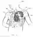 Fig. 02 - Method and apparatus to terminate ventricular tachycardia via pacing