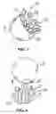 Fig. 03 - Breast implant