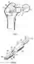 Fig. 02 - Hip prosthesis