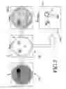 Fig. 06 - Metal artifact correction in computed tomography
