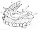 Fig. 01 - Denture