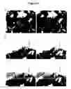 Fig. 03 - Method of treating amyotrophic lateral sclerosis