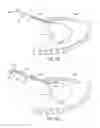 Fig. 09 - Method for cardiac restraint