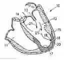 Fig. 01 - Method for treating myocardial rupture