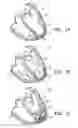 Fig. 02 - Method for treating myocardial rupture