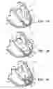 Fig. 03 - Method for treating myocardial rupture