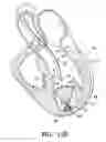 Fig. 13 - Method for treating myocardial rupture
