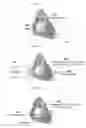 Fig. 02 - MATERIALS AND METHODS FOR IN SITU FORMATION OF A HEART CONSTRAINER