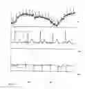 Fig. 05 - Method for continuous, non-invasive, non-radiating detection of fetal heart arrhythmia
