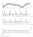 Fig. 06 - Method for continuous, non-invasive, non-radiating detection of fetal heart arrhythmia
