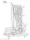 Fig. 05 - Orthopedic inlay