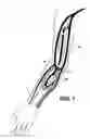 Fig. 02 - Arteriovenous access valve system and process