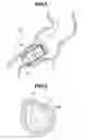 Fig. 06 - Encapsulated medical device and method of examining, curing, and treating internal region of body cavity using encapsulated medical device