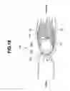 Fig. 17 - Encapsulated medical device and method of examining, curing, and treating internal region of body cavity using encapsulated medical device