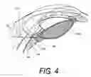 Fig. 09 - Supercavitating medical probe and method of use