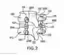 Fig. 03 - Apparatus and methods for spinal implant with dynamic stabilization system