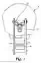 Fig. 02 - Variable geometry occipital fixation plate