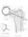 Fig. 11 - Vertebral body having an altered native cancellous bone volume and related treatment methods