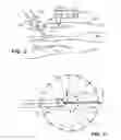 Fig. 03 - Methods and apparatus for removing veins