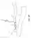 Fig. 12 - Method and apparatus for impeding migration of an implanted occlusive structure