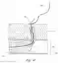 Fig. 30 - Method and apparatus for impeding migration of an implanted occlusive structure