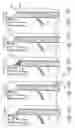 Fig. 33 - Method and apparatus for impeding migration of an implanted occlusive structure