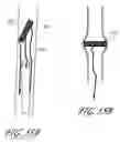 Fig. 53 - Method and apparatus for impeding migration of an implanted occlusive structure