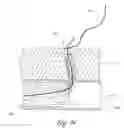 Fig. 30 - Method and apparatus for implanting an occlusive structure