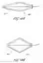 Fig. 40 - Method and apparatus for implanting an occlusive structure