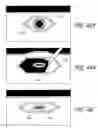 Fig. 44 - Method and apparatus for implanting an occlusive structure