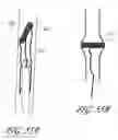 Fig. 53 - Method and apparatus for implanting an occlusive structure