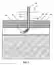 Fig. 02 - Method and a medical closure system for sealing a puncture