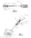 Fig. 02 - Tissue puncture closure device with scroll gear transmission tamping system