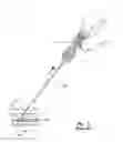 Fig. 03 - Tissue puncture closure device with scroll gear transmission tamping system