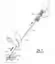 Fig. 04 - Tissue puncture closure device with scroll gear transmission tamping system