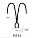 Fig. 09 - Anchoring System for Valve Replacement